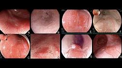 Портсмутская классификация при пищеводе Барретта The Portsmouth acetic acid classification (PREDICT).